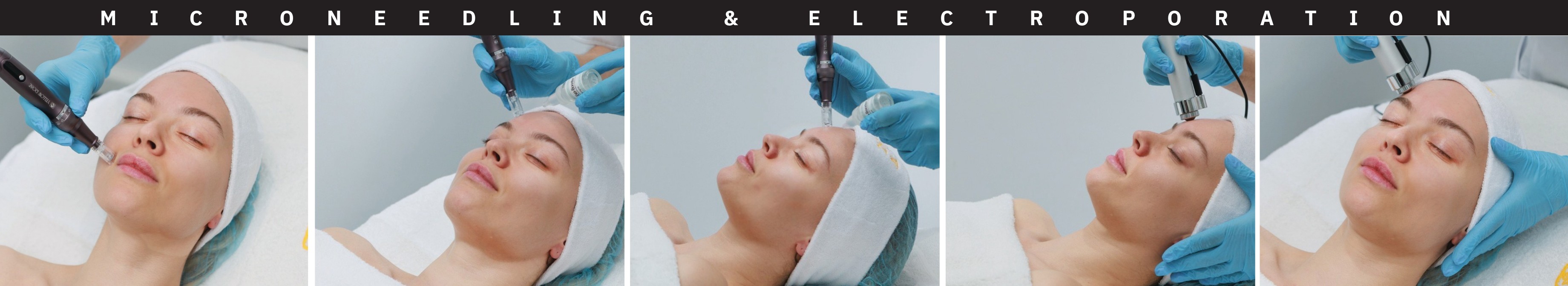 microneedeling-electroporation-yellow-rose-charde-orez